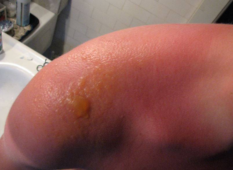 Sunscreen helps prevent sunburn, such as this, which has blistered