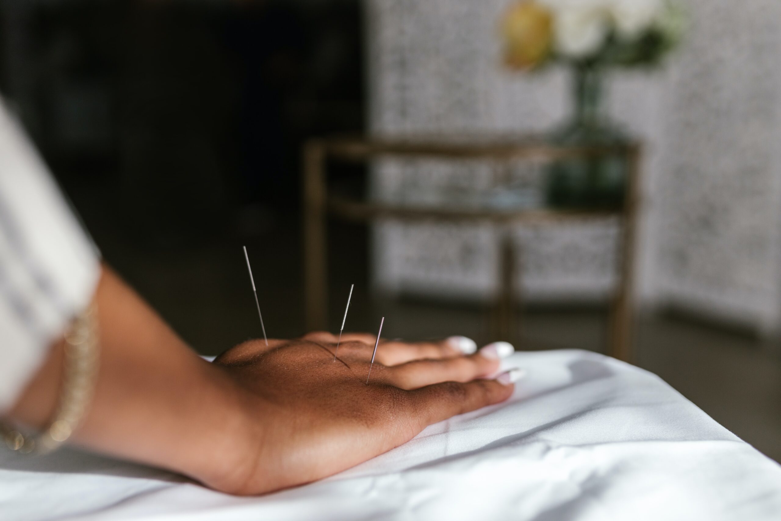 A person having an acupuncture treatment